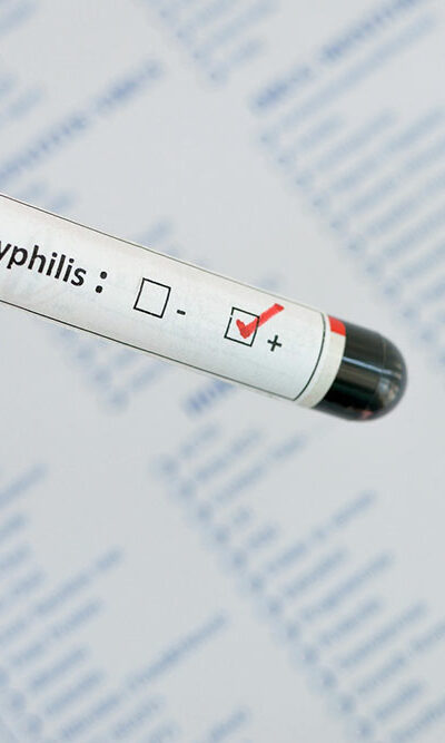 Syphilis &#8211; Early Signs and Diagnosis