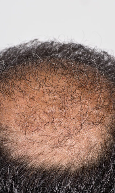 Hair Transplant &#8211; Types, Procedure, and Cost